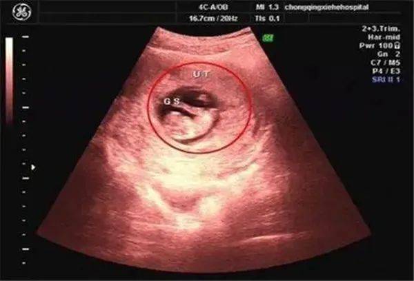怀孕肚子中线看男女图图片