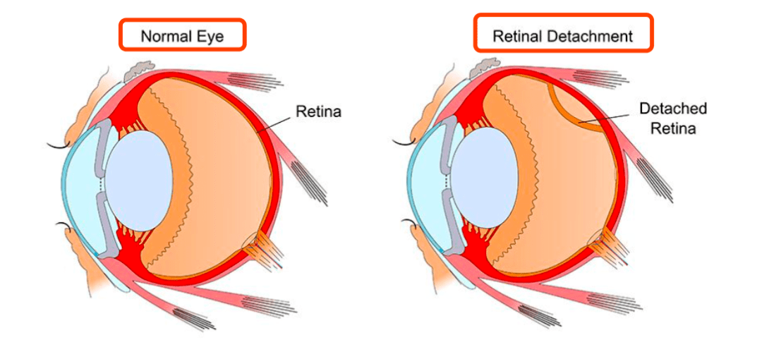 視網膜脫落是視網膜的神經上皮與色素上皮分離,當眼球發生猛烈衝擊