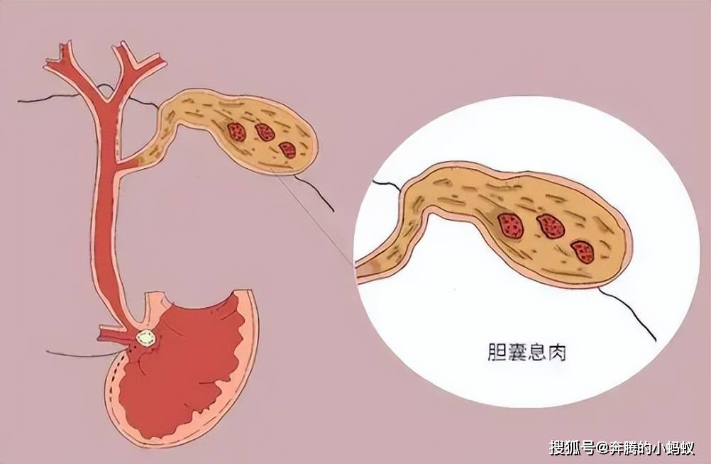 难以割舍的胆囊息肉
