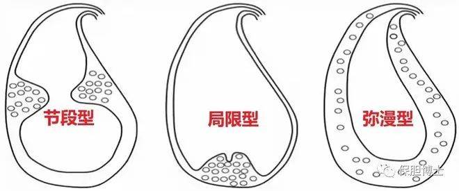 体部或体颈交界处,形成节段性增厚,胆囊囊腔变窄,可形成环形狭窄环,将