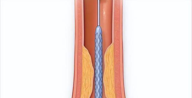 心臟支架手術又稱冠狀動脈支架植入術,一般是指將球囊導管通過血管