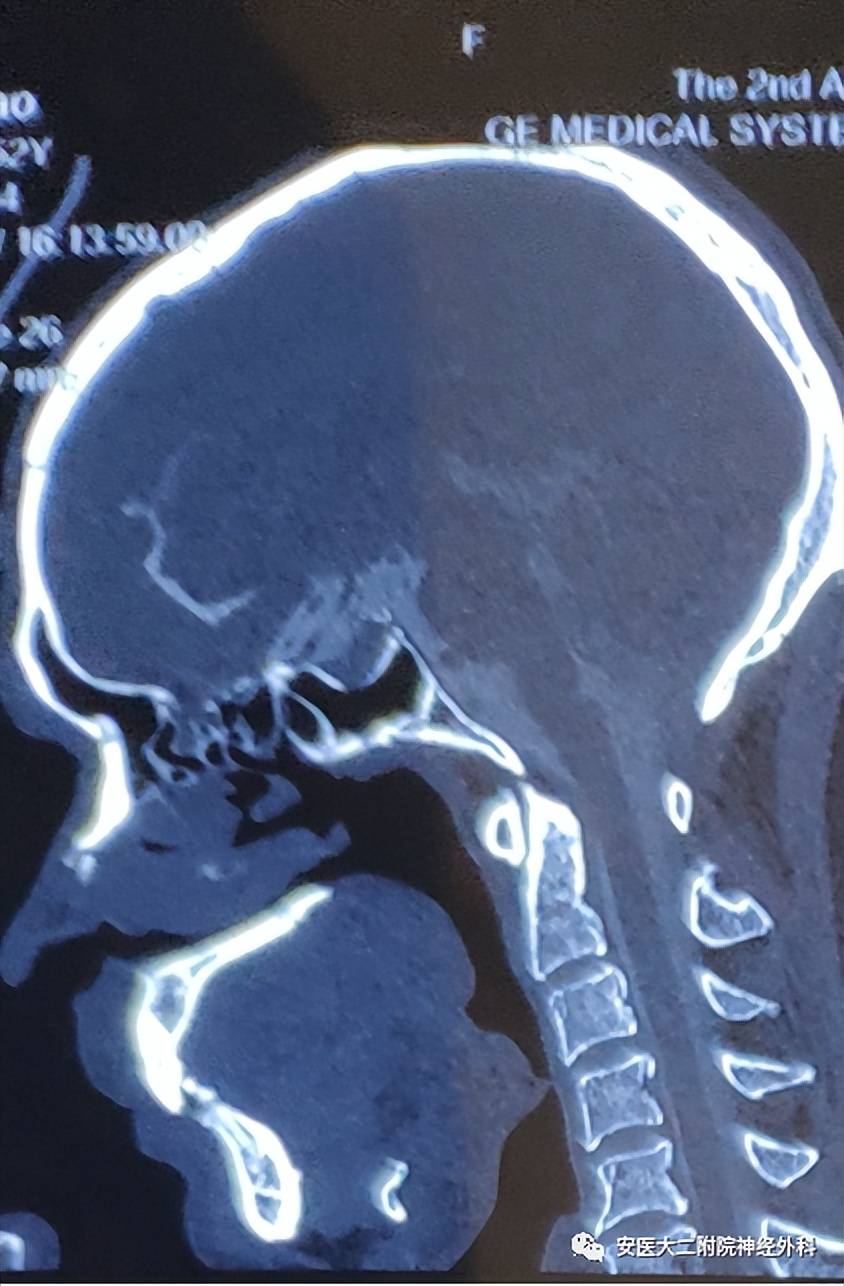 图1 术前脑池造影三维ct: 显示左侧筛骨水平板可见骨质缺损,少许造影