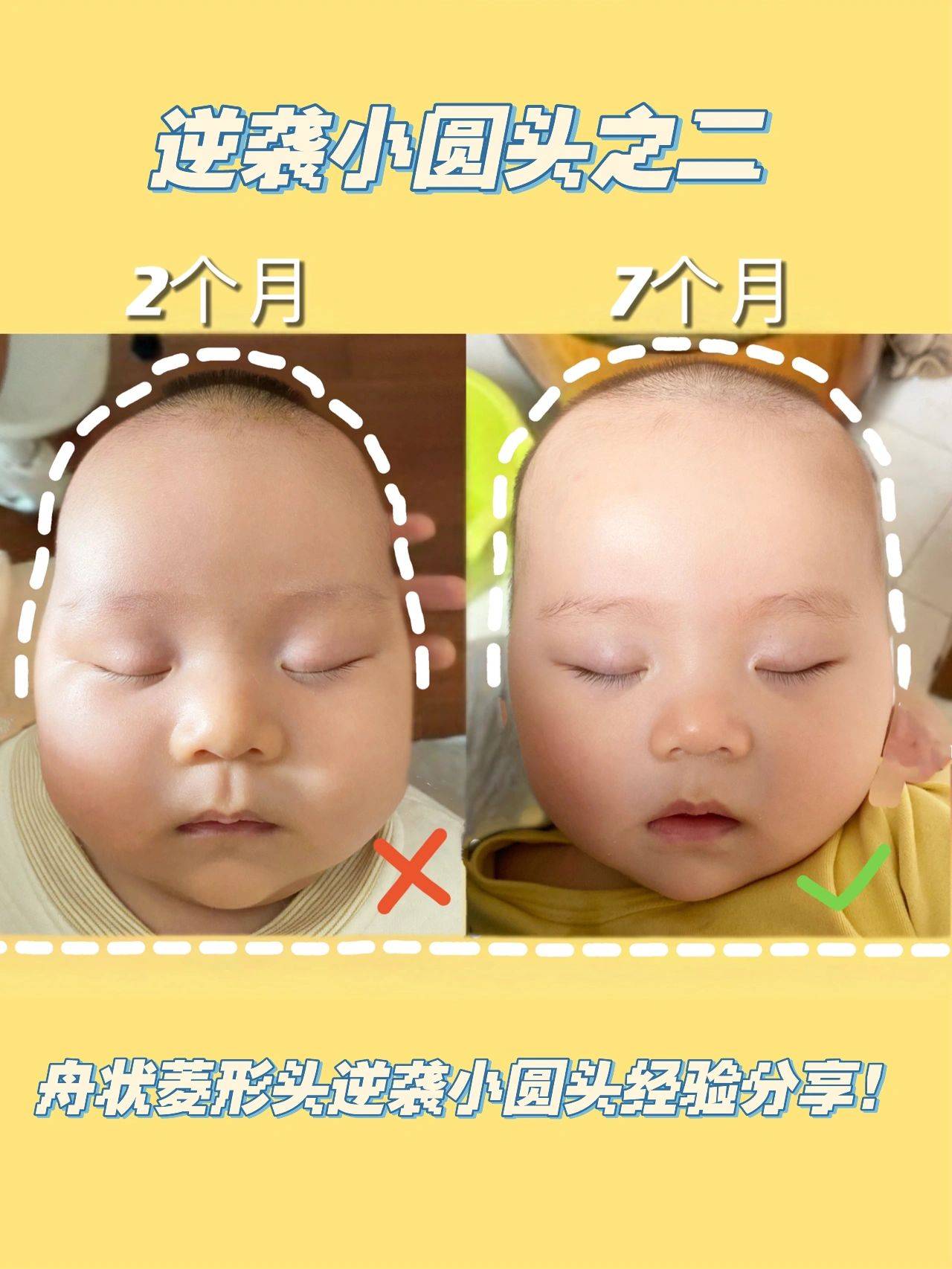 宝宝头型矫正，教你矫正睡姿，从偏头睡成小圆头！ - 知乎