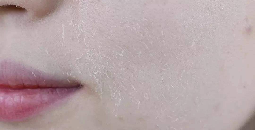 浮粉卡粉不仅影响美观,粉底液还会沉积堵塞毛孔,如果清洗不彻底就会