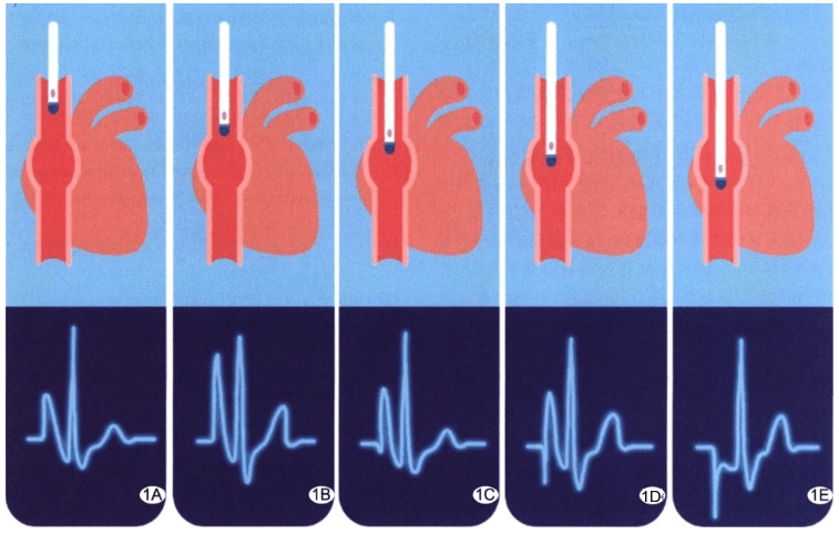 文献汇总腔内心电图定位ecg技术在输液港导管尖端定位中的应用二