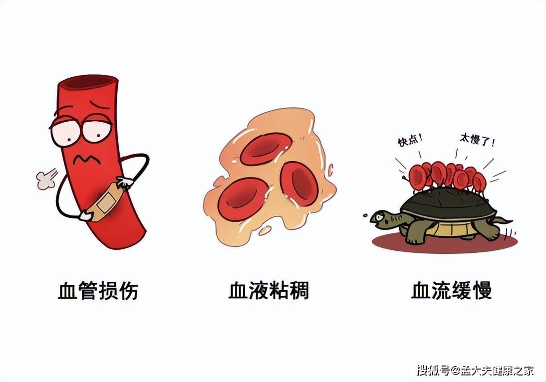 如何"避免脑梗死",做到3个坚决,让你的生活更健康_患者_李先生_脑血管