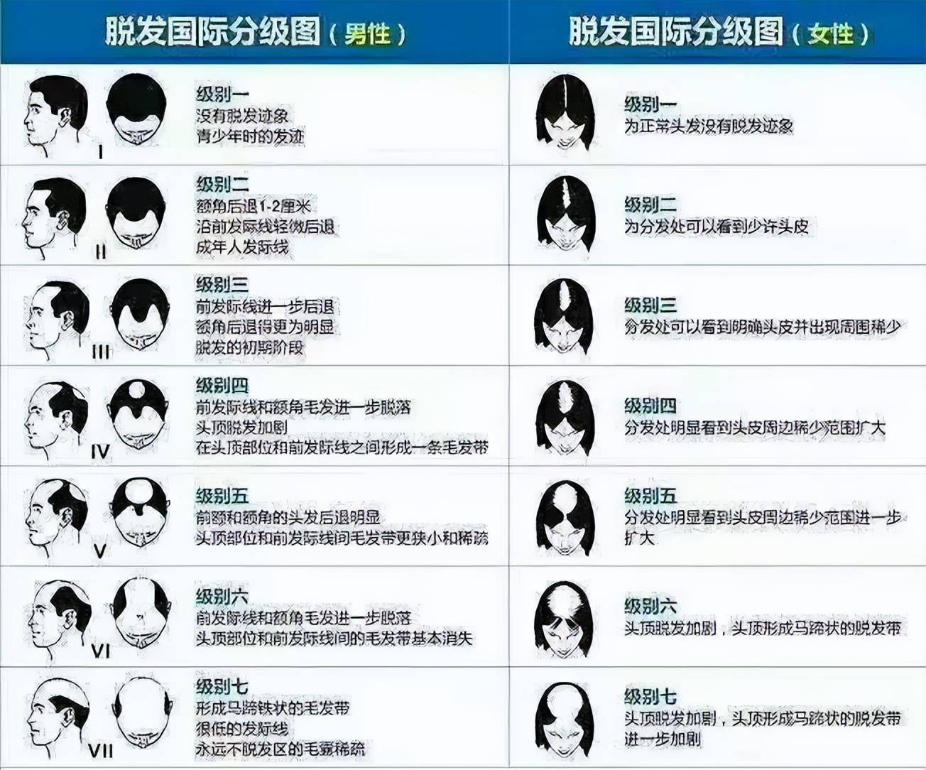 掉发按不同的严重程度可以分成7个等级!超4级就很严重了