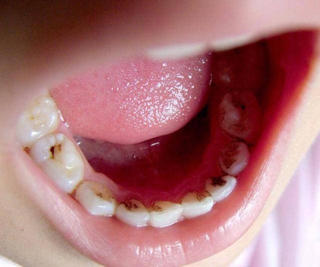 宝宝从六个月左右长出第一颗牙齿,一直到3岁前,20颗小乳牙会完全萌出