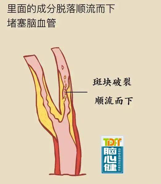 动脉斑块脱落危及生命科学防治是控制斑块脱落的关键