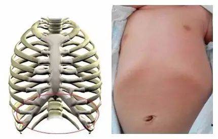 肋骨外翻指的是宝宝胸廓最下方的肋缘向外翻出的现象,一般仔细观察,都