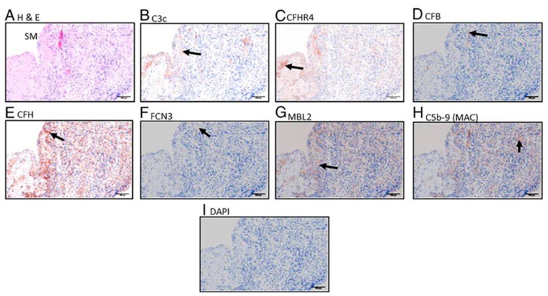 8色多重荧光免疫组化方法揭示补体在早期类风湿关节炎发展中的作用_临床_蛋白_局部