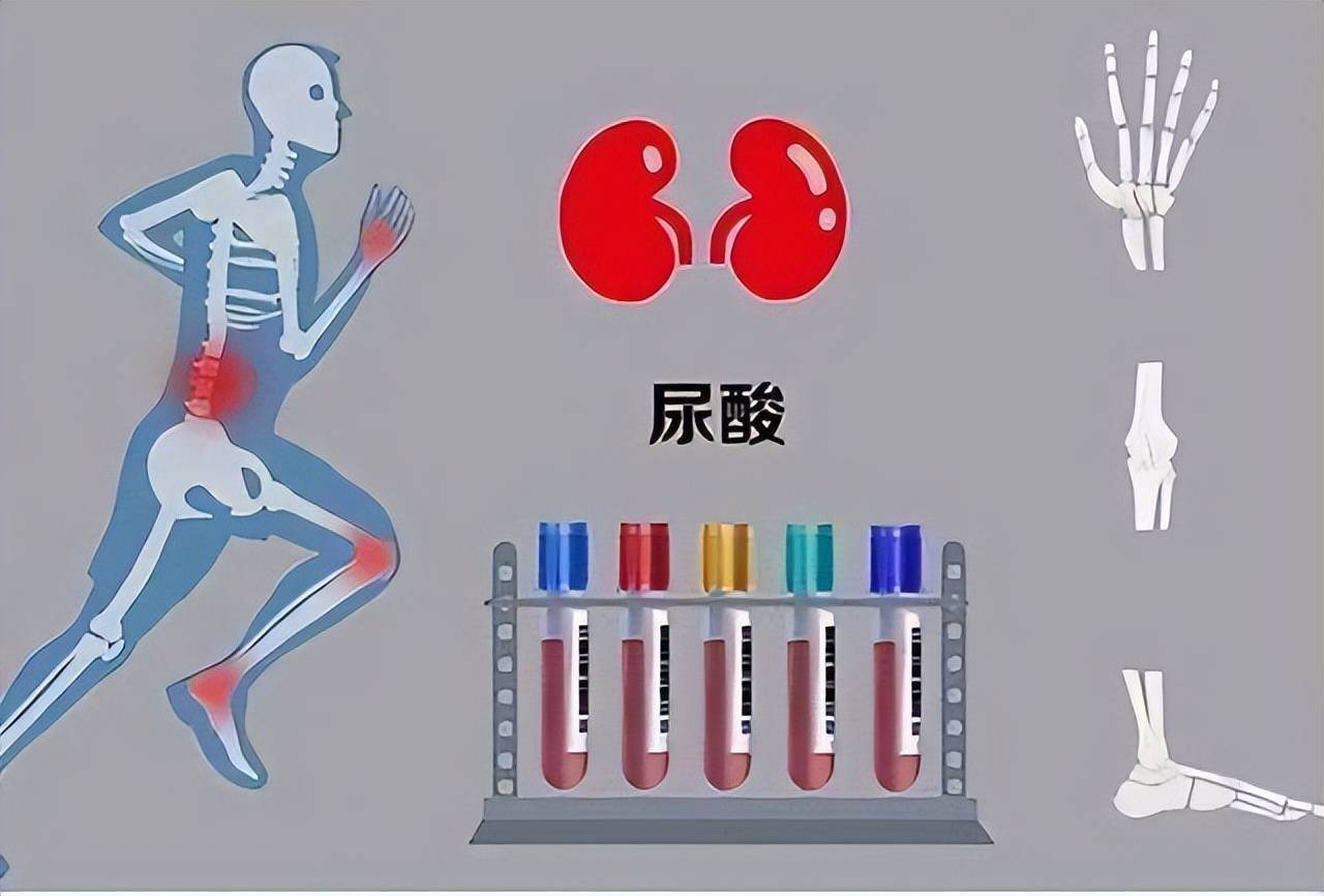 长期高尿酸,身体或有5个危害,高尿酸来临,身体会有什么异常?