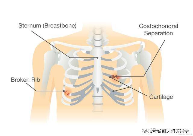 胸骨固定板 又名胸部肋骨骨折固定夹板 心胸外科手术胸部夹板 材质哪种好 产品 材料 患者