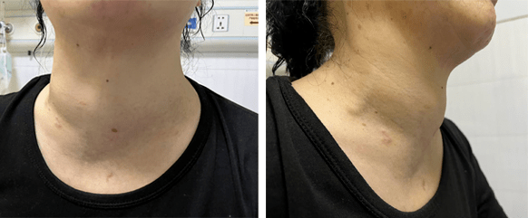 体检查出甲状腺结节到底要不要紧