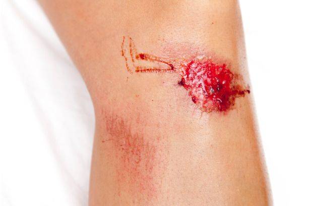 5个处理方法要做好,注意预防感染_伤口_损伤_进行