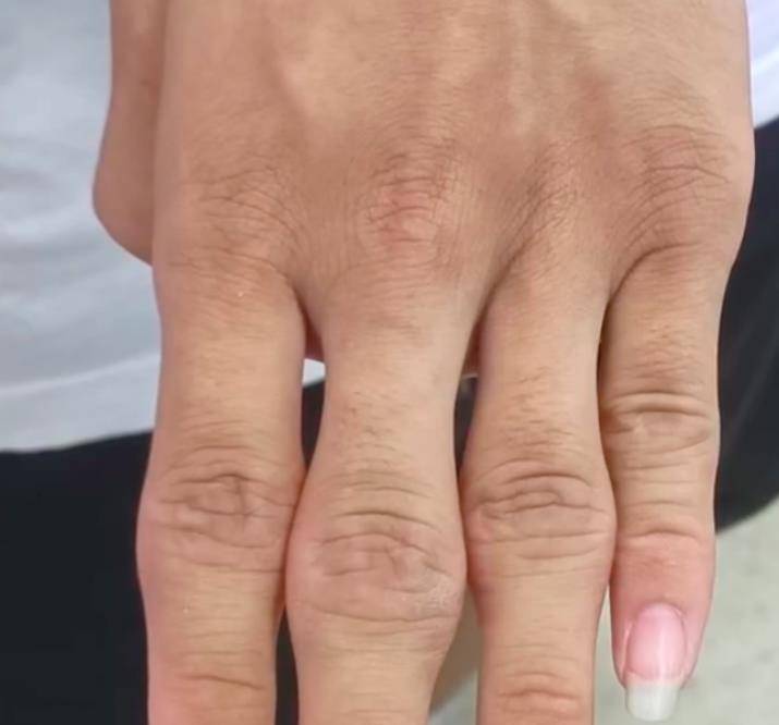 指致双手变形,医生:他经常和同学比较谁掰手指的声音大_关节_朱磊