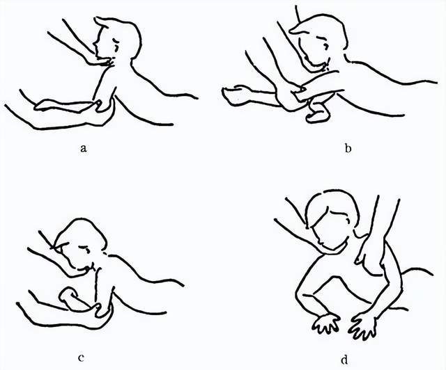 坐位痉挛型小儿脑瘫要使髋关节弯曲才能坐下可以双臂穿过腋下,顶住