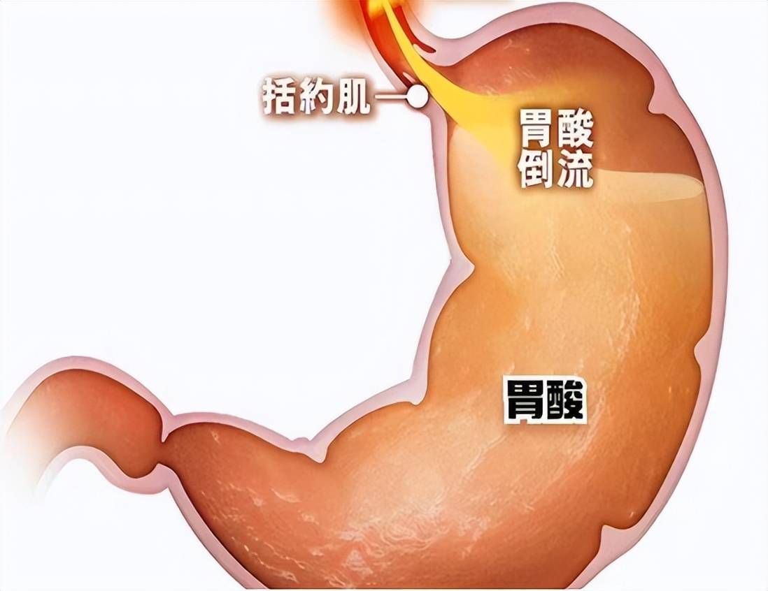 胃酸,是胃腺壁细胞分泌的盐酸,作用是激活胃蛋白酶原,杀死通过食物