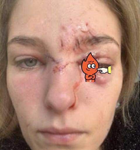 原创知名模特被宠物狗咬伤脸部毁容眼睛险失明受伤照曝光触目惊心