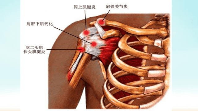 喙肱肌肌腱炎图片