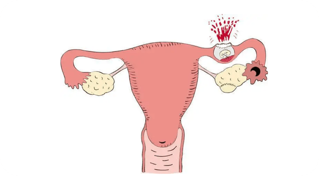 人流后出血多少天正常 听我好好来介绍_子宫_营养_损伤