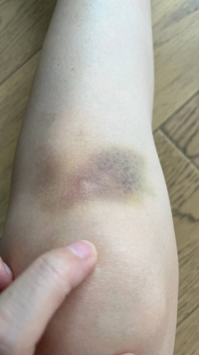 腿摔青紫的图片图片