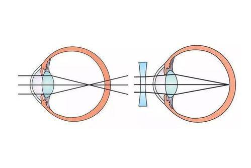 第二:眼內的晶狀體和角膜曲率發生了改變!