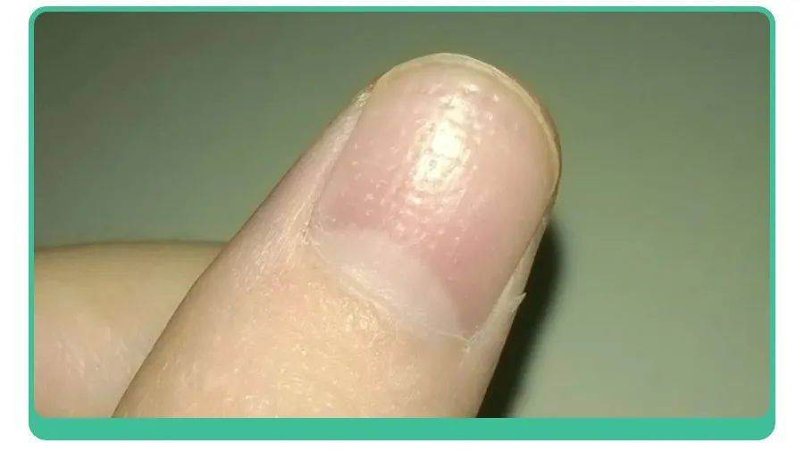 白斑、薄脆、凹陷,娃指甲有异常,不是缺营养,可能暗藏疾病