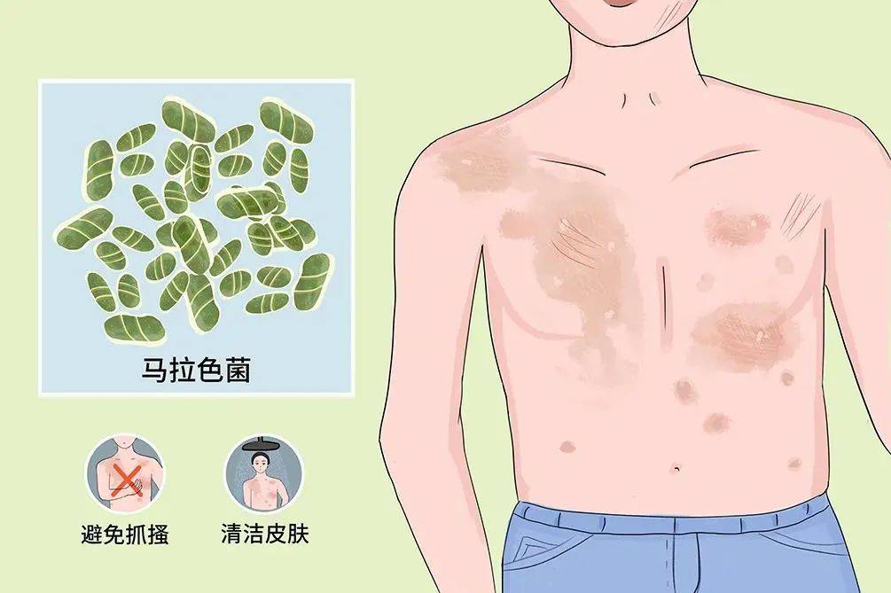 夏日"汗斑"高发,防治汗斑不可少!_马拉_物品_皮肤