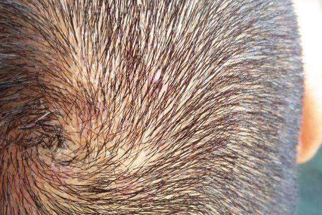 头皮上经常长脓包和疙瘩,是咋回事?