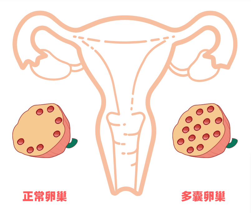 多囊卵巢b超图图片