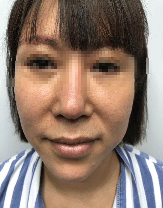 拉皮失败后,看她如何一秒回春不留痕?_手术_面部_切口