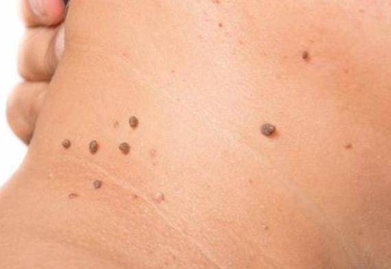 hpv病毒分为多种,丝状疣感染是比较常见常见的,所以不妨安下心来.