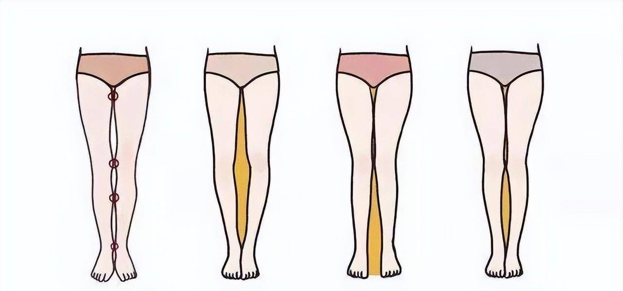 5)形成髋内外旋,膝内外翻,即x型腿,o型腿.