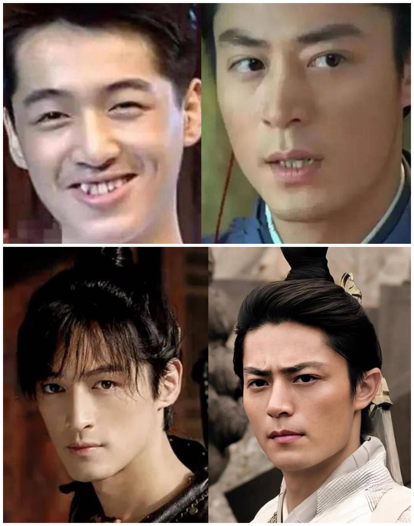 胡歌是右上凸出一颗牙齿,霍建华是左下凹进去一颗牙齿.