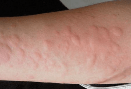 遇突然的冷或热刺激也会发作,皮疹小如芝麻,大如蚕豆,类似于过敏反应