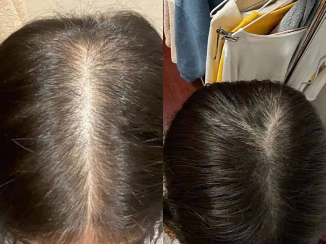 脱发严重怎么办掉多少根头发才算脱发