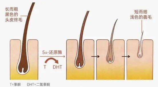 代谢中会产生双氢睾酮(dht),双氢睾酮(dht)可以通过攻击一部分毛囊