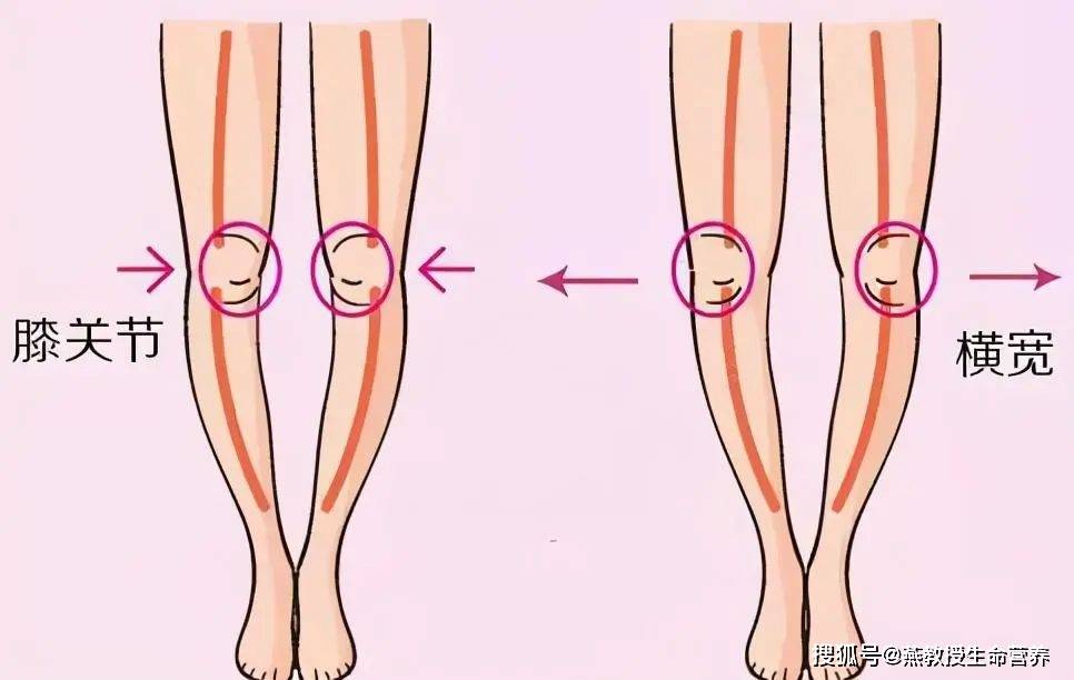膝关节畸形如膝内外翻,俗称o型腿,x型腿,是因为肥胖会让膝关节内