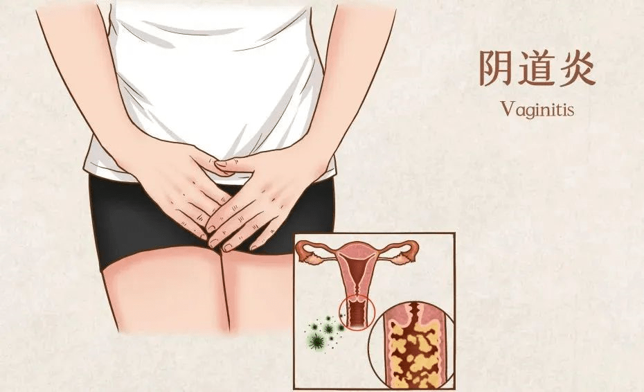 女性尿道分泌物红褐色图片