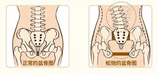 而产后的骨盆骨骼移位,加上不正确的行走,坐卧姿势