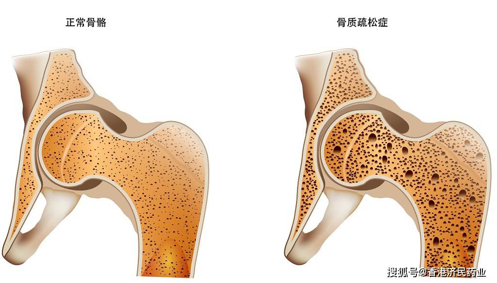 骨折风险降低70%以上！骨质疏松症新药romosozumab增加骨形成 