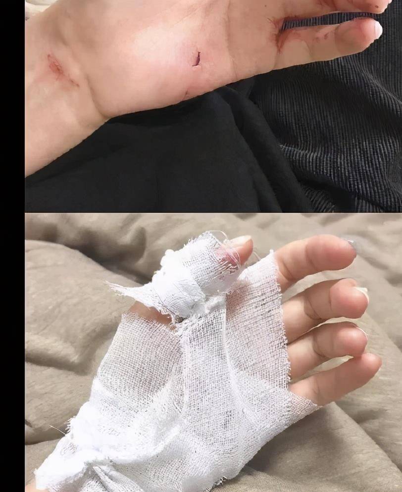 随后还晒出了几张自己受伤的照片,照片中她的手和胳膊上有明显的伤痕.