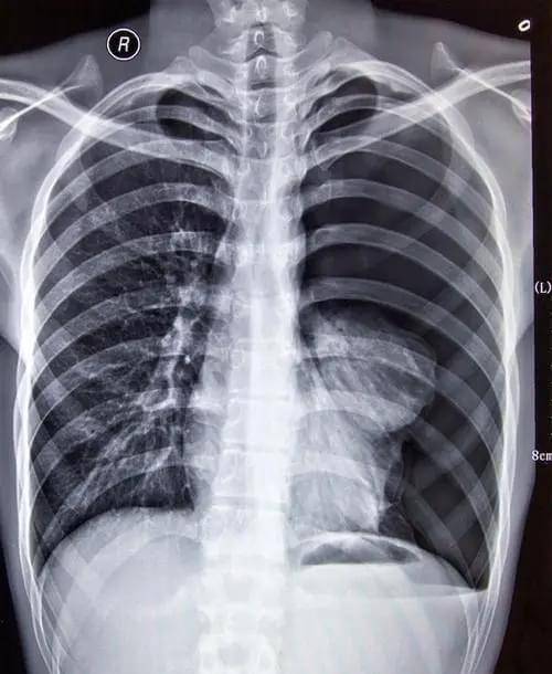 有时可见局限性透亮度增高,表现为局限性肺气肿或肺大泡.