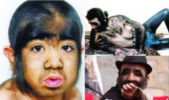 毛发过多的也只是由于其毛发基因发生突变导致多毛,而形成的"返祖现象