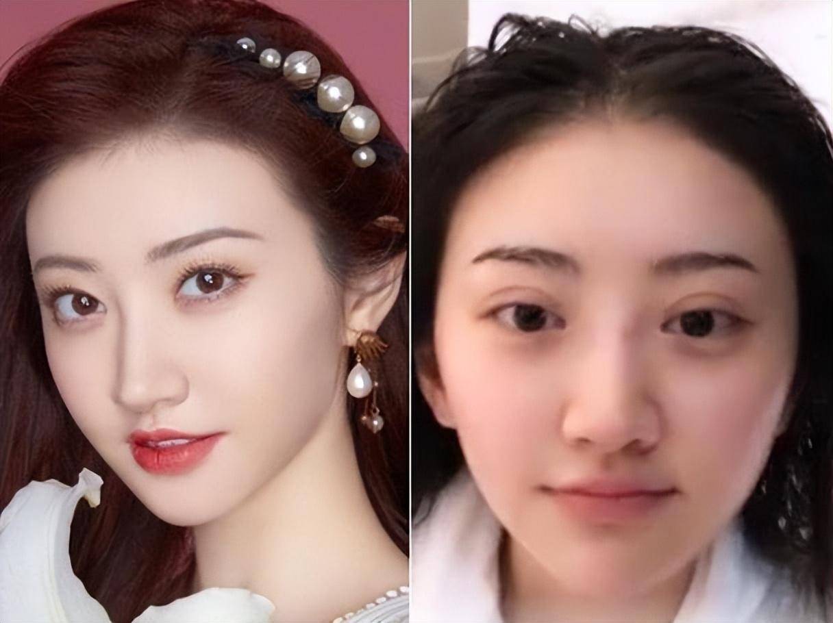 景甜自曝整容失败,坦言差点抑郁,修复完成后悲伤蛙变成甜心女神_风险