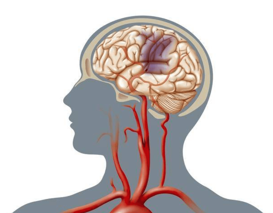 脑梗死有什么办法治疗?如何避免中风脑梗?_患者_脑部_运动