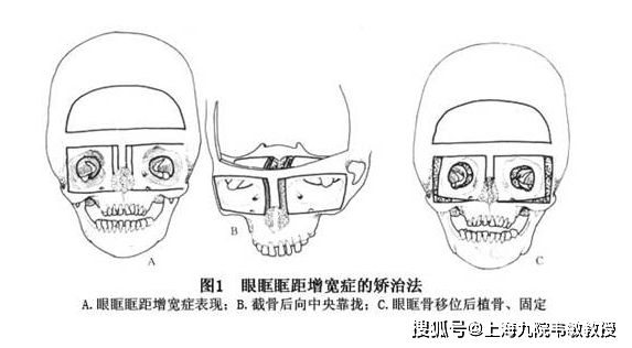 九院韦敏 | 眶距增宽症相关科普(第一期)_眼眶_mm_进行