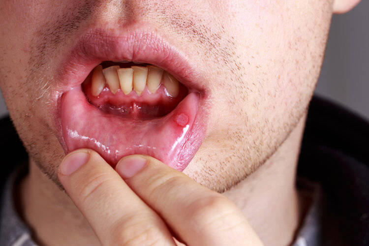 恶性口腔溃疡的特征图片