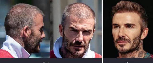 脾气火爆的地狱神厨戈登拉姆齐,马斯克都植发成功了噢!